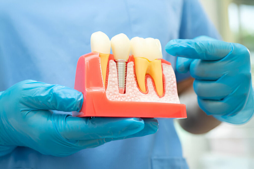 Dental Implant Aftercare Tips: How to Ensure Long-lasting Success