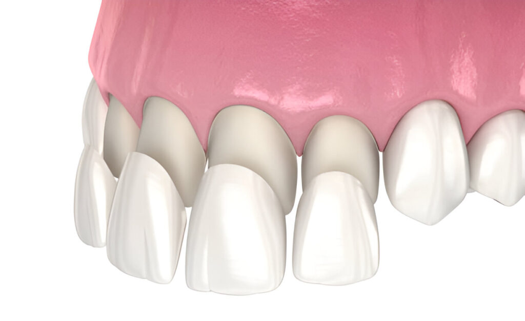 How to Choose the Right Type of Porcelain Veneers for Your Smile_FI