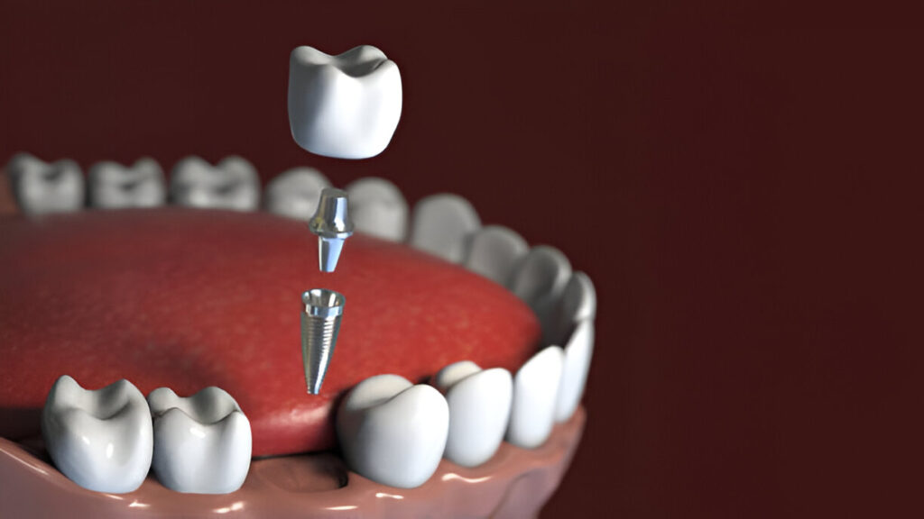 Killeen Dental Group Explains Why Dental Implants Are the Best Option with Your Dentist in Killeen, TX_3