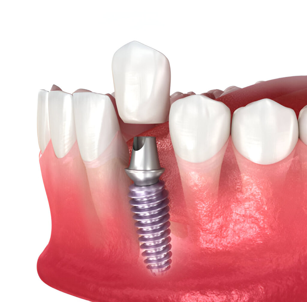 Killeen Dental Group Explains Why Dental Implants Are the Best Option with Your Dentist in Killeen, TX_FI