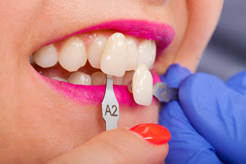 Discover the Best Dentist in Killeen, TX for Porcelain Veneers Killeen Dental Group_2