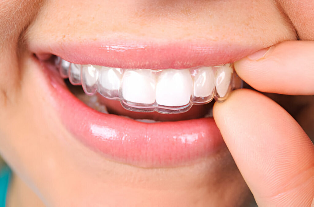 Achieve a Beautiful Smile with Invisalign at Killeen Dental Group in Keller, TX_2